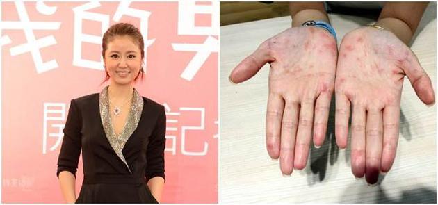 林心如四肢突然长满红疹  怎么回事?